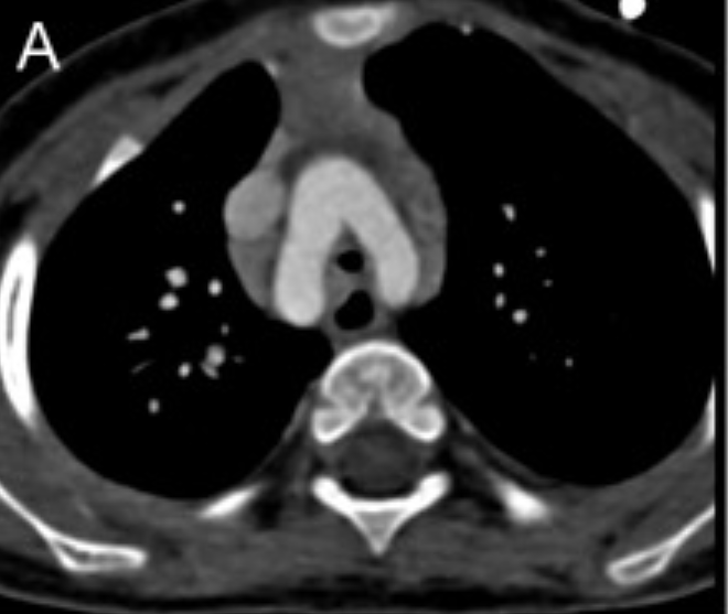 Ct axial image demonstrates a double aortic arch