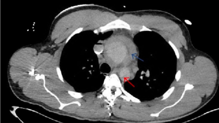 Ct chest ascending aortic dissection
