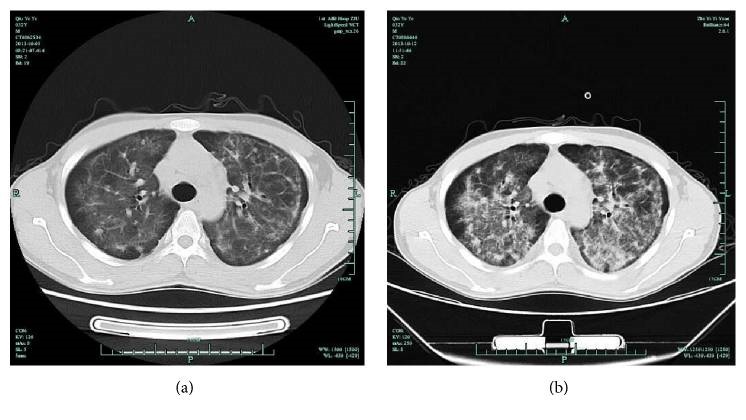 Ct chest in an aids patient with pneumocystis pneumonia