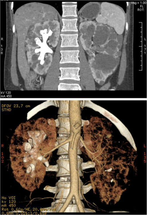 Ct complete staghorn calculus in right kidney autosomal dominant polycystic kidney disease