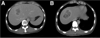 Ct images of a liver abscess