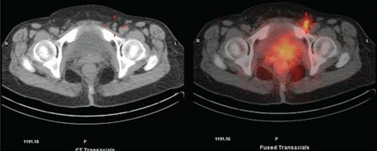 Imágenes de tc de la pelvis que muestran un ganglio linfático inguinal izquierdo agrandado