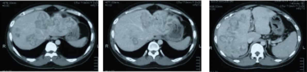 Ct metastasis from sigmoid colon cancer