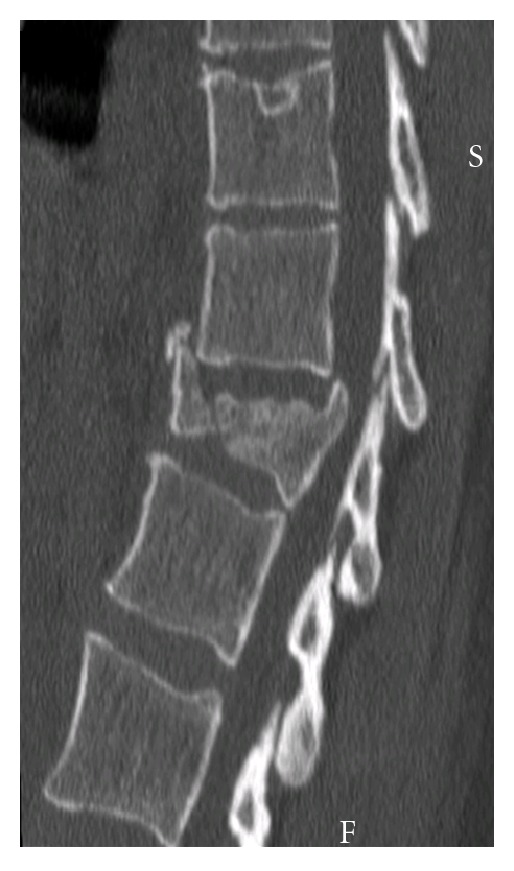 Ct of burst fracture of t12