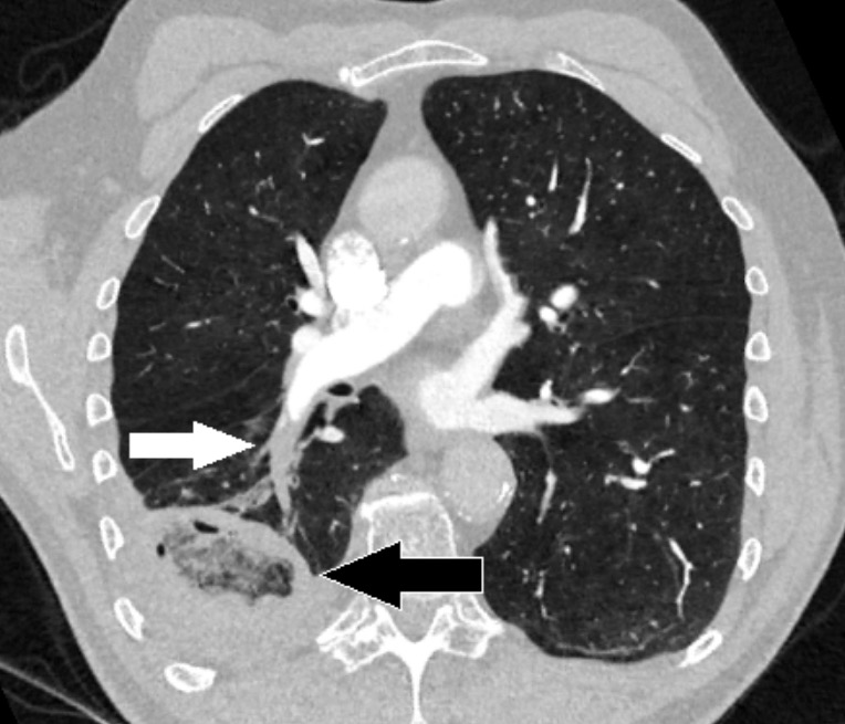 Ct of lung infarction with reverse halo sign