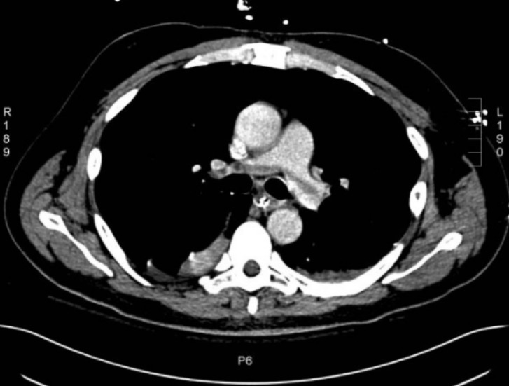 Ct of saddle pulmonary embolism