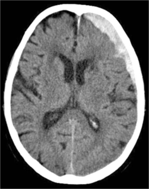 Ct scan demonstrating the fronto-temporal subdural hematoma over the left hemisphere