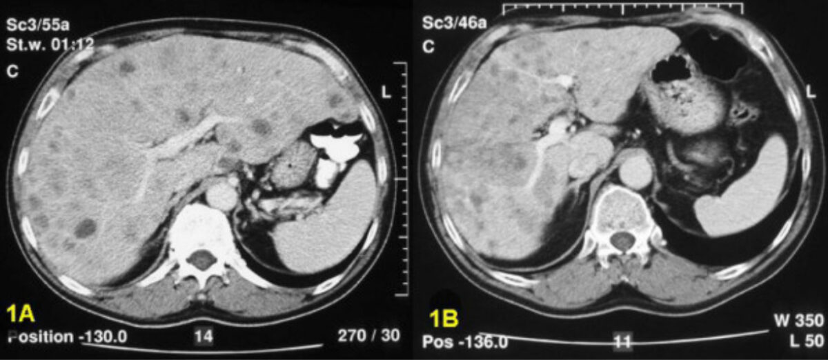 Tomografia computadorizada com múltiplas lesões carcinoides metastáticas