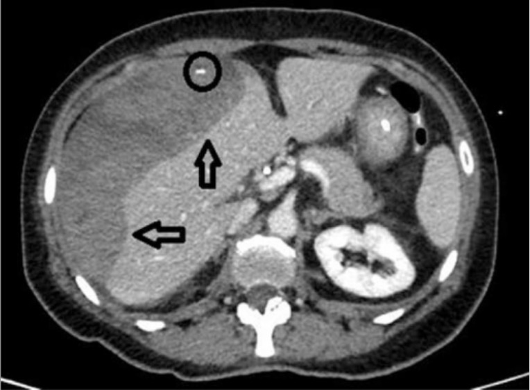 Ct scan of middle abdomen showing a subcapsular hepatic hematoma