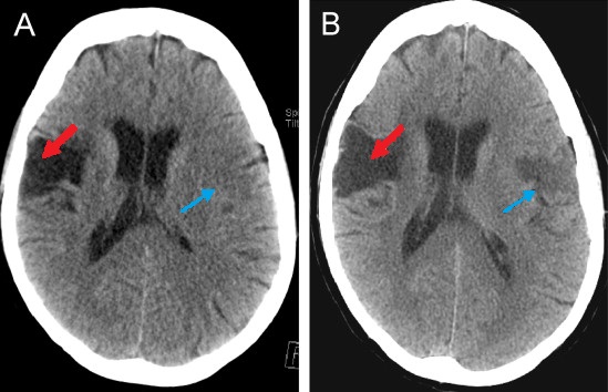 Tomografia computorizada de um doente com acidente vascular cerebral no território da artéria cerebral média
