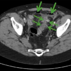 CT scan of perforated diverticulitis