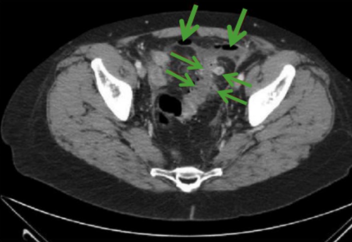 Ct scan of perforated diverticulitis