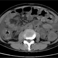CT scan of pseudomembranous colitis