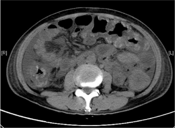 Ct scan of pseudomembranous colitis