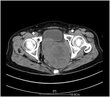 Ct scan of the pelvis showing a mass in the posterior vaginal wall