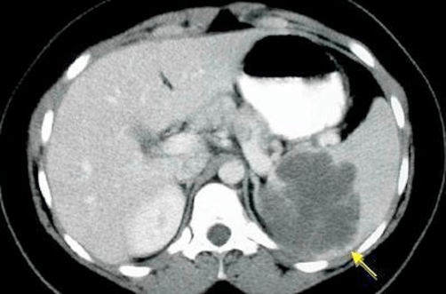 Ct scan of the splenic cyst
