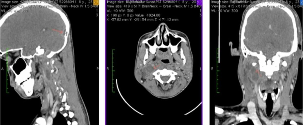 Abscesso parafaríngeo direito de tomografia computadorizada