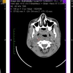 CT scan right parapharyngeal abscess