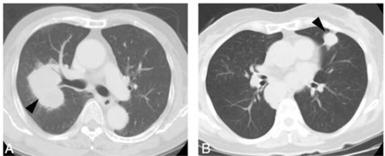 Lambert-Eaton Myasthenic Syndrome | Concise Medical Knowledge