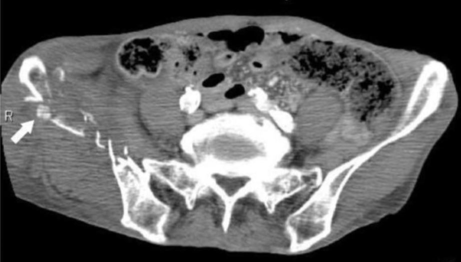 Ct scan showing a fracture of the ilium