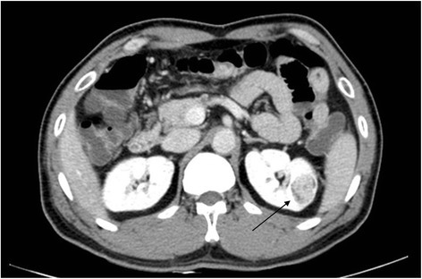 Ct scan showing renal cell carcinoma