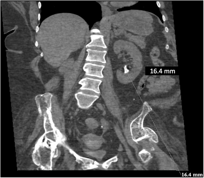 Ct scan showing the left renal stone