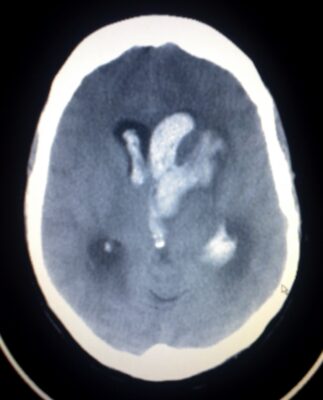 Ct scan showing intracerebral hemorrhage with intraventricular extension