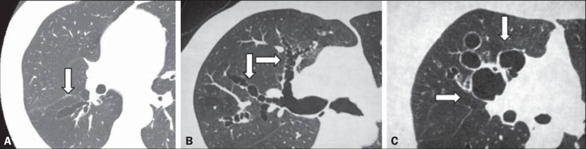Ct showing different patterns of bronchiectasis