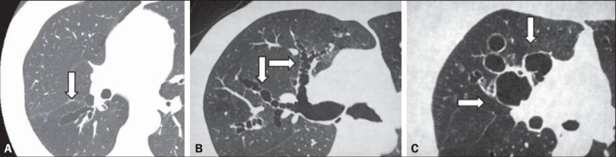 Tc com diferentes padrões de bronquiectasias