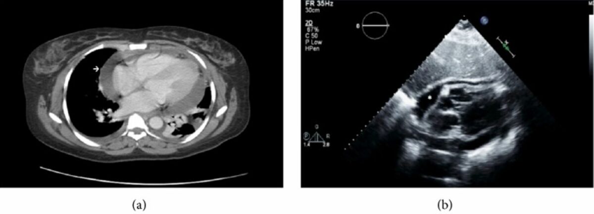 Ct shows cardiomegaly with large pericardial effusion