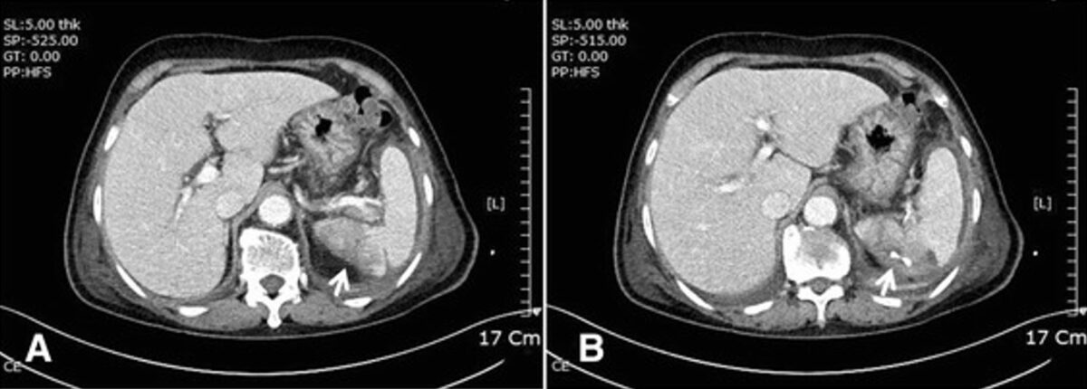 Ct splenic infarction and abscess with percutaneous drainage