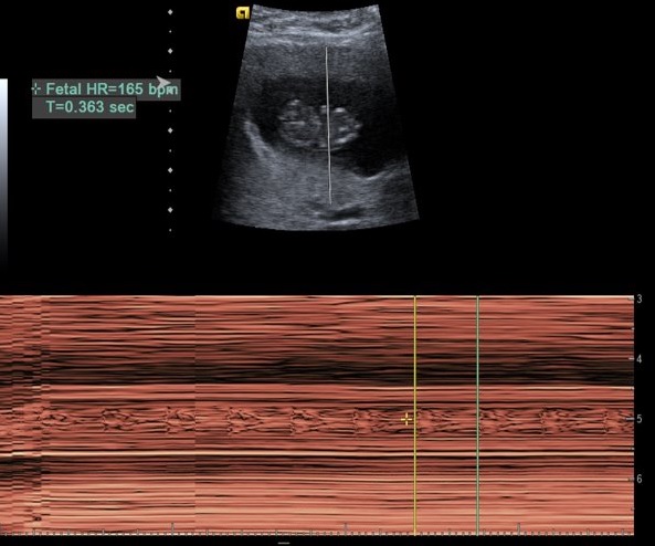 Calculation of the fetal heart rate by ultrasound