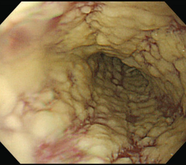 Candida esophagitis