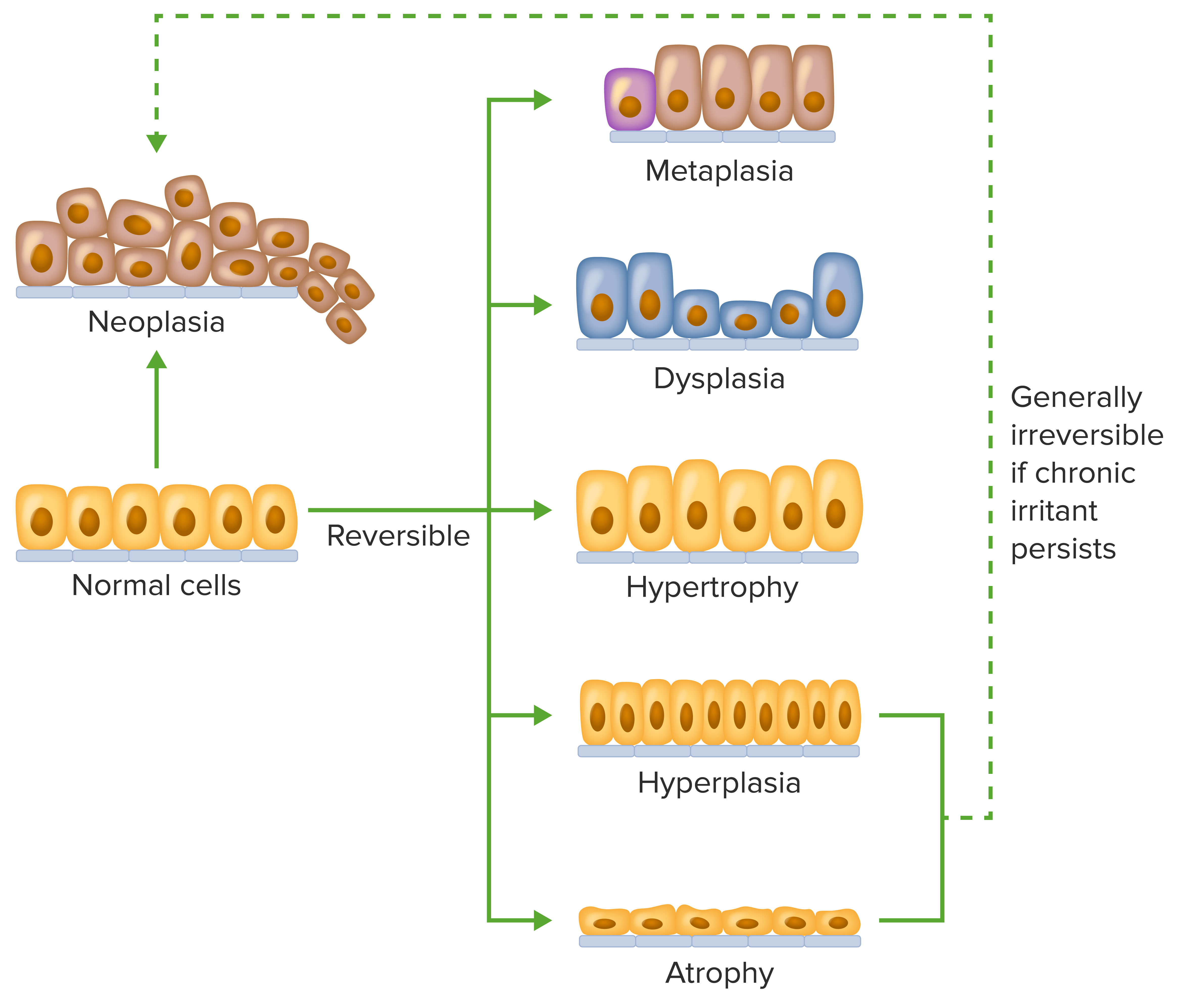 Metaplasia and dysplasia: Video, Anatomy & Definition