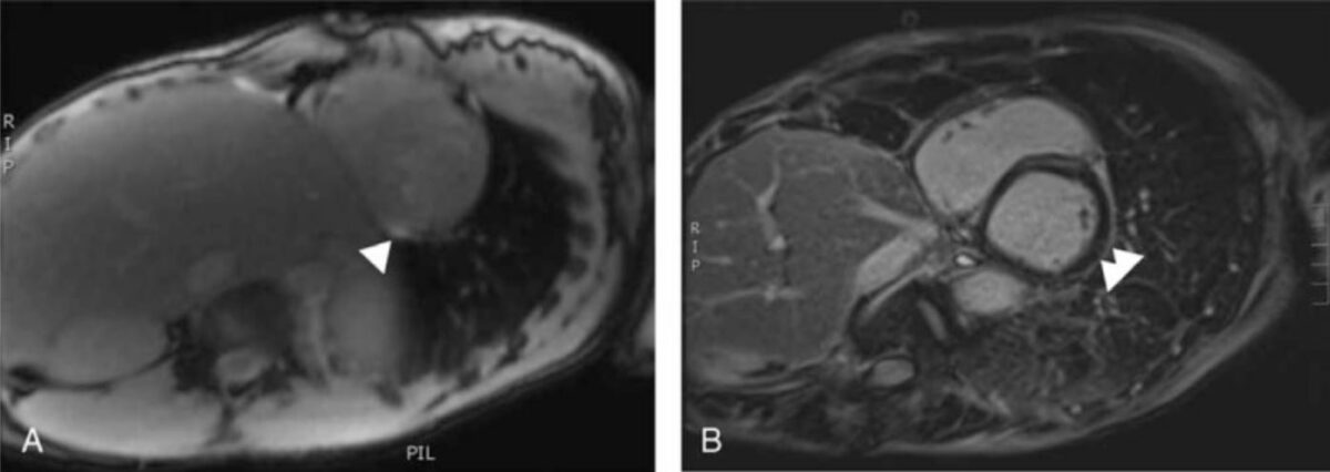 Cardiac mri suggestive of myocarditis