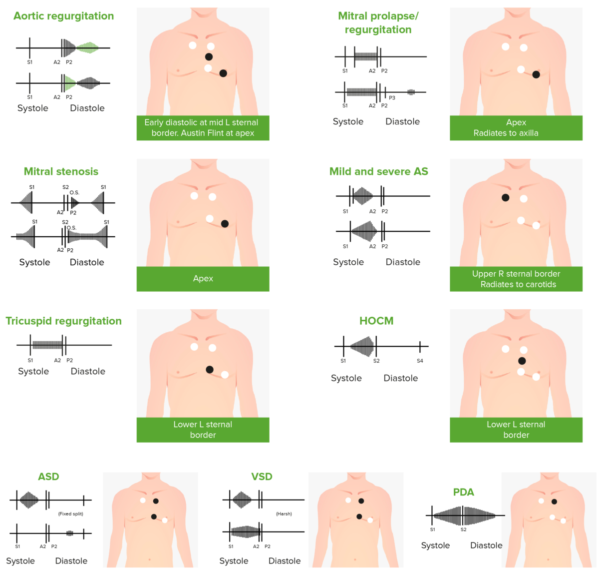 Cardiac murmurs after correction