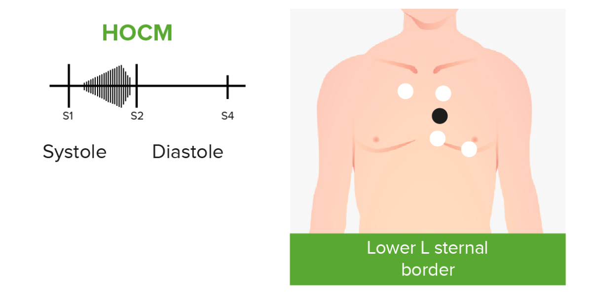 Cardiac murmurs in hocm