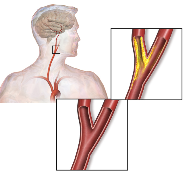 Estenosis de la arteria carótida