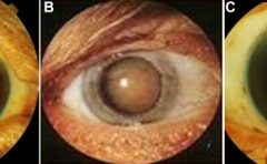 Cataract examples
