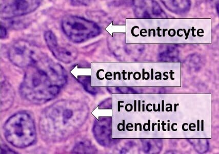 Centrocyte, centroblast and follicular dendritic cell in a follicular_lymphoma