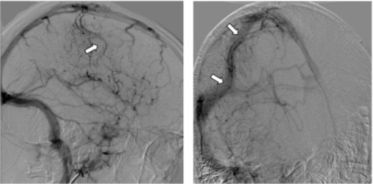 Trombosis venosa cerebral en dos pacientes con hipotensión intracraneal espontánea - angiografía cerebral