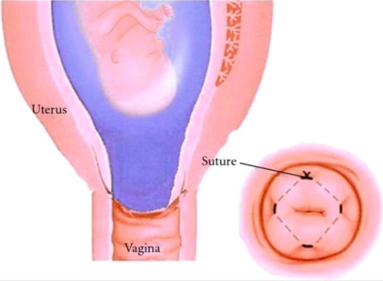 Cervical cerclage