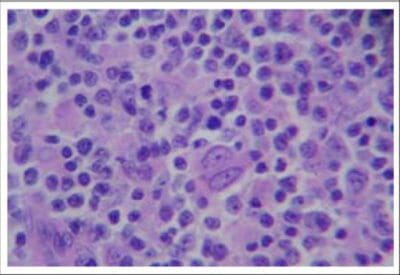 Linfadenopatía | Concise Medical Knowledge
