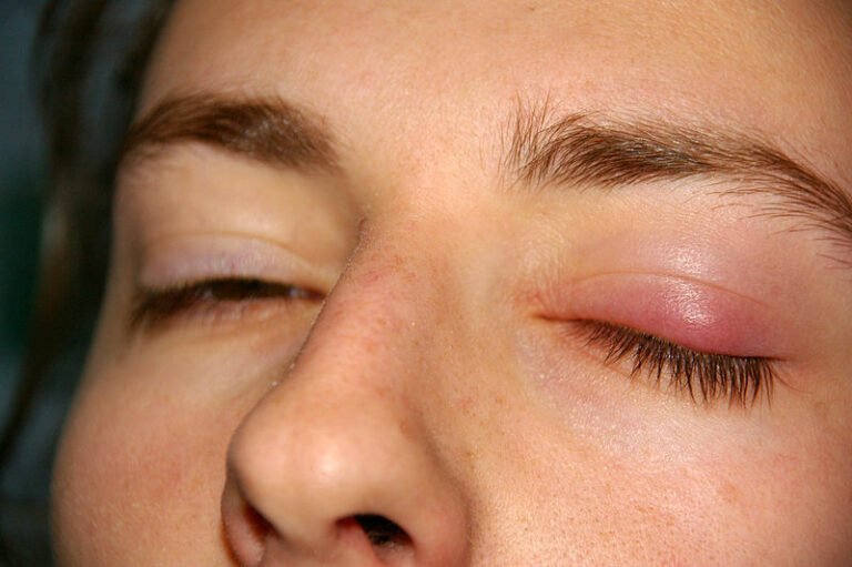 Chalazion (Clinical) Concise Medical Knowledge