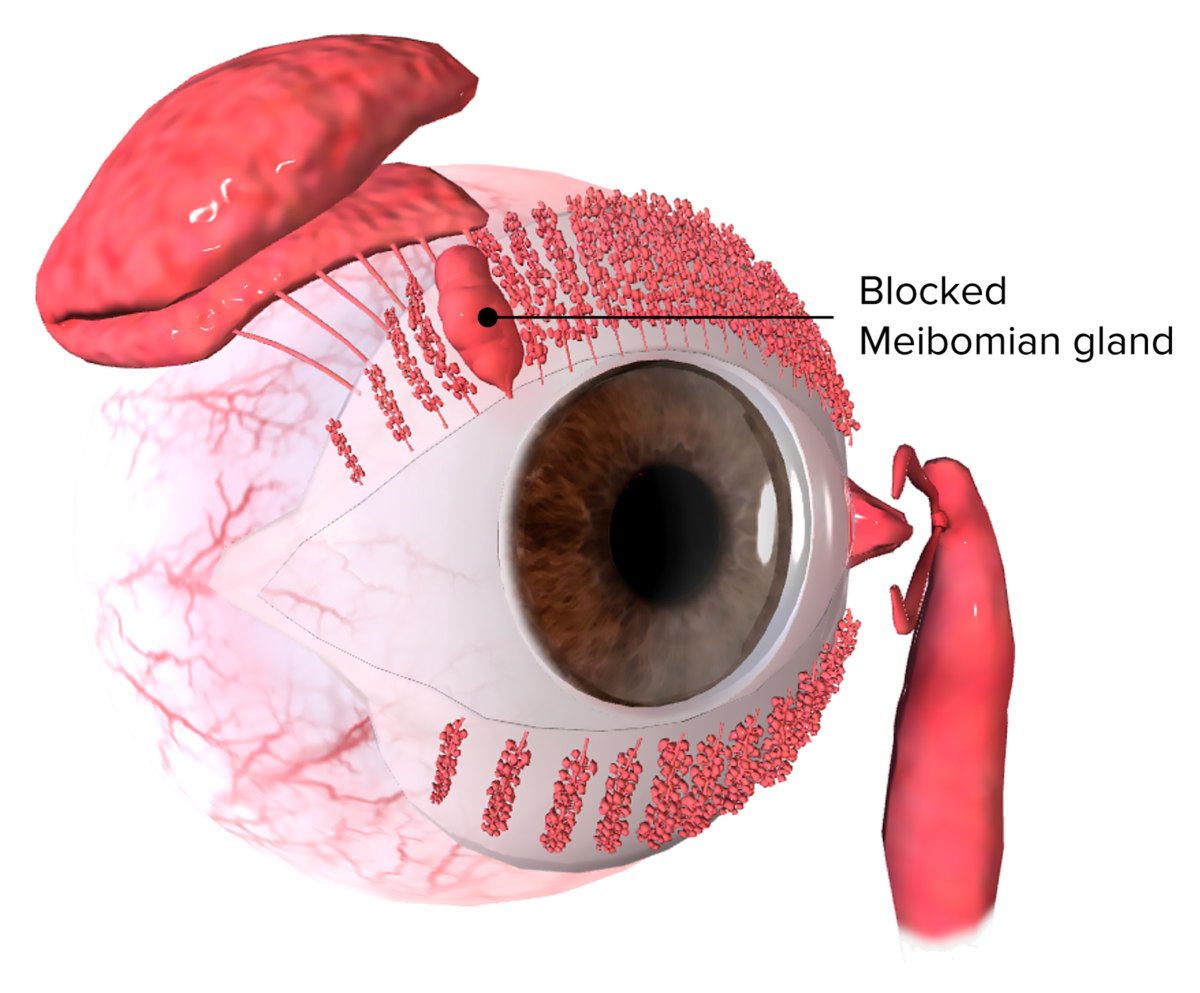 Chalazion causes