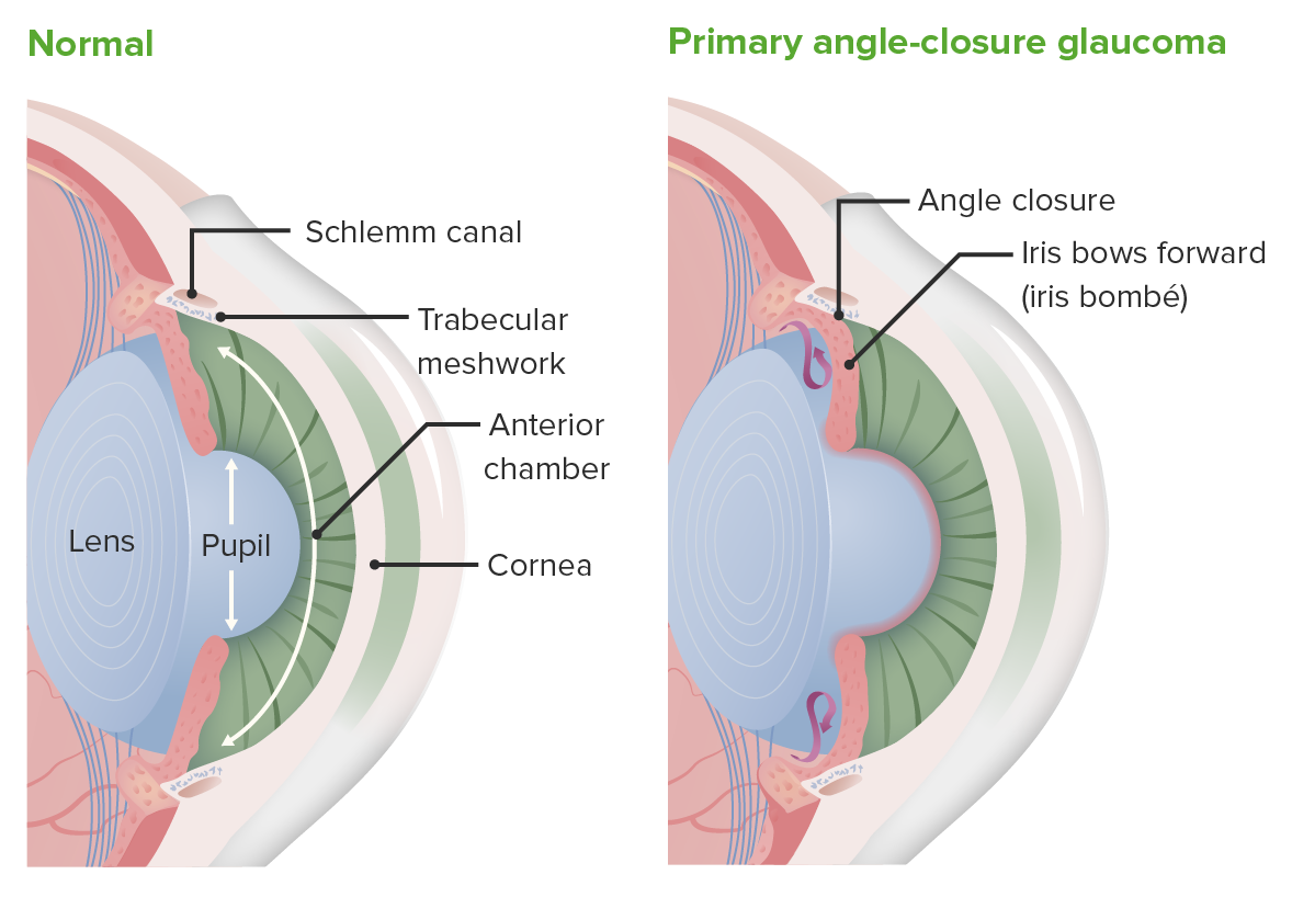 Changes that occur with closed angle glaucoma