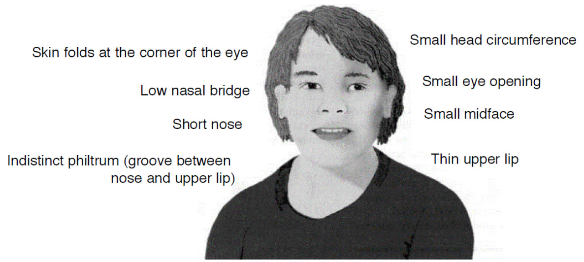 Rasgos faciales característicos de un individuo con trastorno del espectro alcohólico fetal