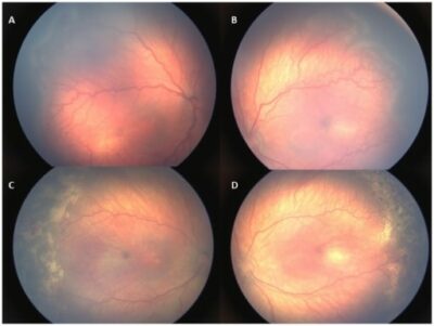 Retinopatía Del Prematuro | Concise Medical Knowledge