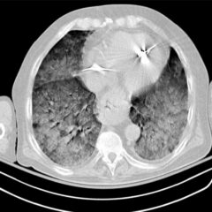 Chest CT scan indicative of severe ARDS