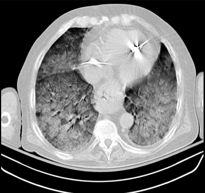 Chest ct scan indicative of severe ards